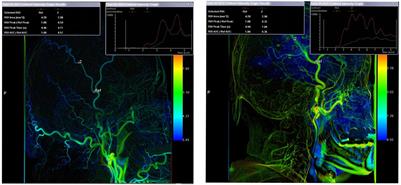 Indirect revascularization vs. non-surgical treatment for Moyamoya disease and Moyamoya syndrome: A comparative effectiveness study